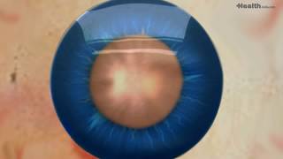 Cataract Surgery -how it is performed