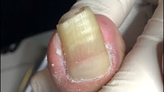 Very very long nail treatment