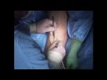 Double Surgical Incision