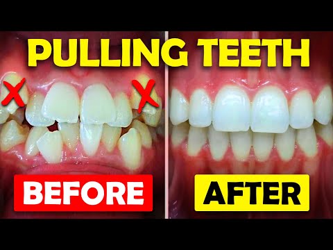 Why do you have to get a tooth pulled before radiation?