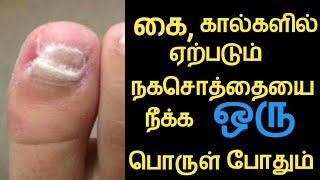 How to treat fungus nail/நகச்சொத்தை குணமாக எளிய வழி/UT Health