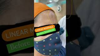 Linear Morphea| Dermal fillers Treatment | Dermatologist in Chandigarh | Mohali | Punjab