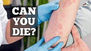 Can Psoriasis Be Fatal?