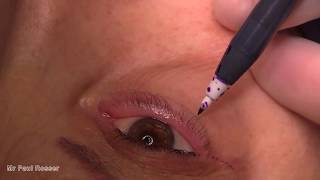 Lower lid involutional entropion repair