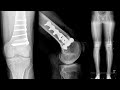 Lateral Meniscal Allograft Transplantation With Distal Femoral Osteotomy and Fresh OATS