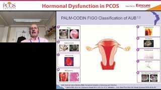 Prof. Nick Panay : Abnormal Uterine Bleeding in PCOS