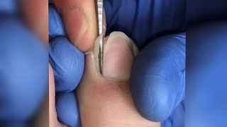 SUPER DEEP INGROWN REMOVAL USING A BLADE!!!!