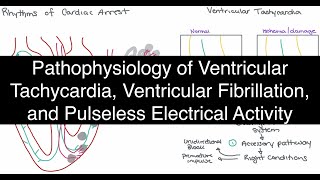 Pathophysiology of Ventricular Tachycardia (VT), Ventricular Fibrillation (VF), and PEA