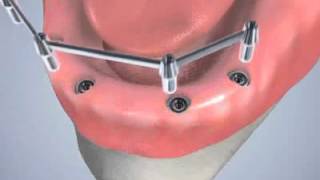 Austin Advanced Dentistry | Implant Supported Dentures -  Bar Supported Denture