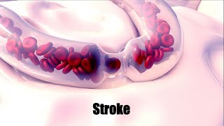 What is a stroke?