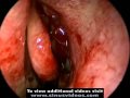 Basic Endoscopic Sinus Surgery