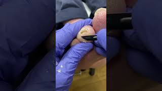 Diabetic Ulcer Follow-Up: Expert Callus Removal by Australian Podiatrist