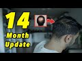 14 Month 2nd Hair Transplant Update | 4000 GRAFTS FUE | SLOW AND STEADY