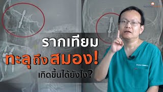 รากเทียม ทะลุถึงสมอง!!!...เกิดขึ้นได้ยังไง? | คุณหมอตี้ขยี้ข่าว | Dentalimage