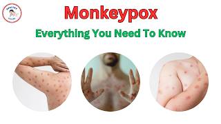 Crucial Facts About Monkeypox You Need to Know Now