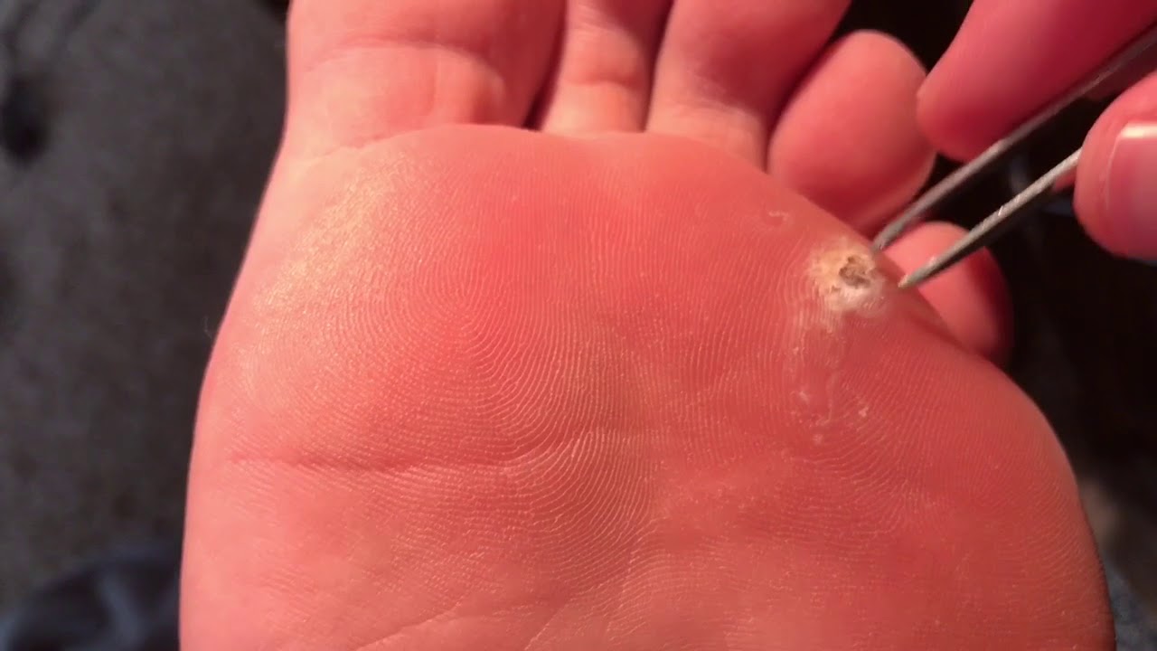 DAY 53: Plantar Wart Removal Update: Digging Out The Middle Again ...