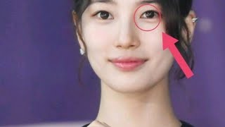 Suzy's Brave Battle: The Mole Removal That's Making Headlines!\