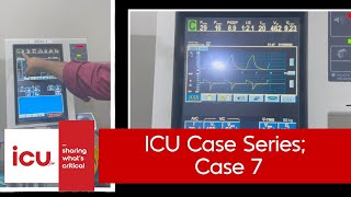 ICU Case series - ICUcase 7 (ventilator mechanics, high peak pressures; but what's causing them??)