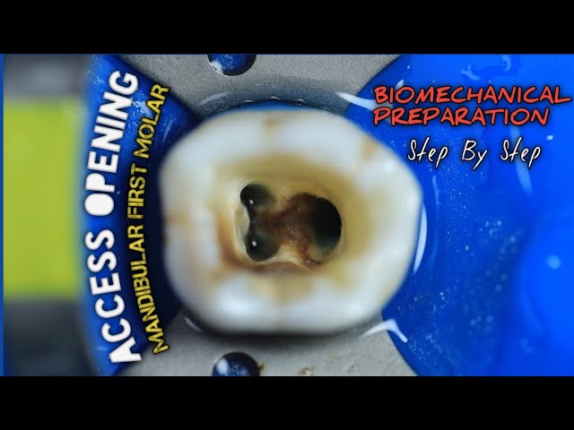 Mandibular First Molar Canals Root Canal Morphology Of Permanent