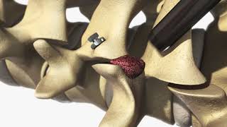 Spineology: Capture Facet Fixation System