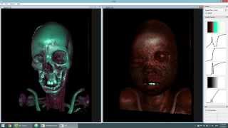 Interactive Volume Ray Casting on GPU