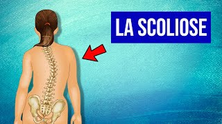 Soigner la Scoliose : Les Traitements