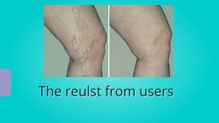 How to relief your varicose vein in 2 weeks with natural way