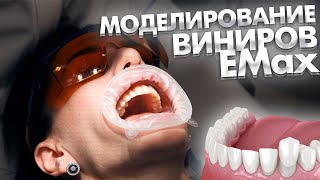 Как добиться идеальной эстетики виниров EMax?  WAX-UP и MOCK-UP.  Моделирование и примерка виниров