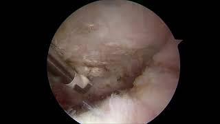 Arthroscopic Distal Clavicle Excision - Surgeon Version