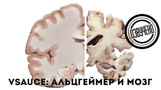 Vsauce: мозг и болезнь Альцгеймера