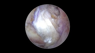 All-Inside PCL Reconstruction Using a Quadriceps Tendon Autograft