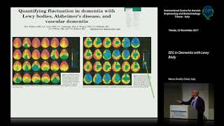 M. Onofrj - EEG in Dementia with Lewy Body