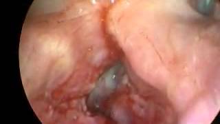 Laryngeal Cancer