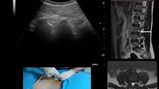 Ultrasound guided transforaminal epidural steroid injection