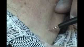 Safely treat skin tags with the touch method...Skin Classic