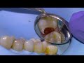 24 major tooth decay restored with a filling