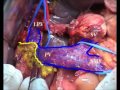 hepatopancreatoduodenectomy with portal vein resection