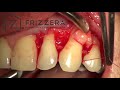 root coverage of multiple gingival recession with caf and connective tissue graft