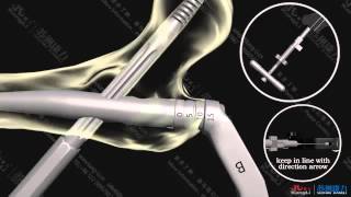 PF Gamma intramedullary nails system__Leon