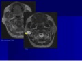 neuroradiology head u0026 neck imaging teaching case 2.wmv