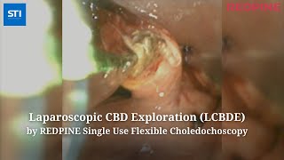 Laparoscopic CBD Exploration (LCBDE) by REDPINE Single Use Flexible Choledochoscopy