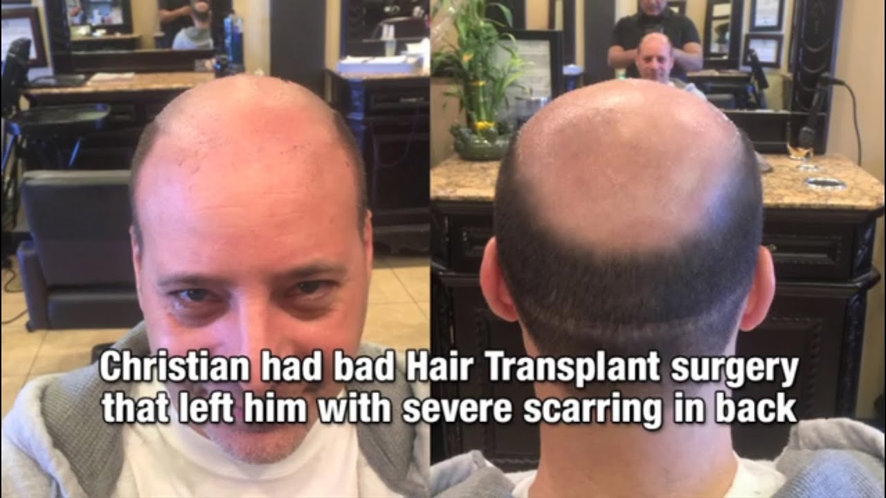 Before After Video Of Micro Scalp Pigmentation Los Angeles Youtube