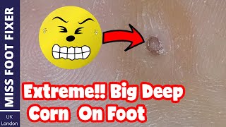 Extreme!! Big Deep Corn On Foot Removal Full Treatment By Miss Foot Fixer