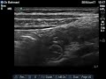 case 166 us in gi tract normal anatomy in small bowel