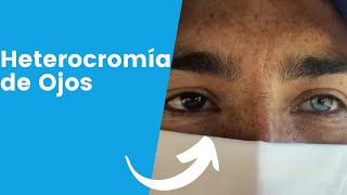 Heterocromia- Ojos de Colores Diferentes