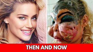 15 Famous Celebrities Unrecognizable After Plastic Surgery Gone Wrong |Then and Now 2026
