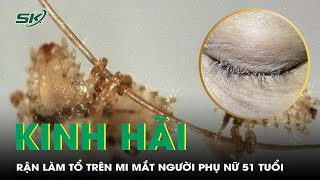 Rận Chi Chít, Đẻ Trứng Làm Tổ Trên Mi Mắt Người Phụ Nữ 51 Tuổi I SKĐS