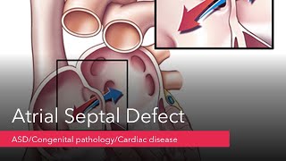 Atrial septal defect/ASD/Types of ASD/Cardiovascular Perfusionist