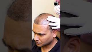 PRP Treatment for Hairloss | Hair Transplant Clinic  | Dadu Medical Centre