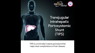 Discover the Minimally Invasive Treatment Option for Liver Diseases: TIPS Procedure| Swagat Hospital